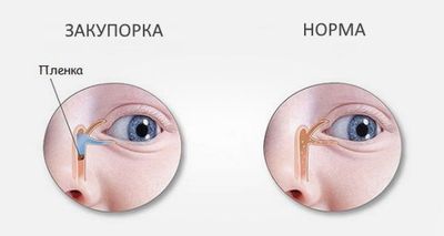 массаж слезного канала