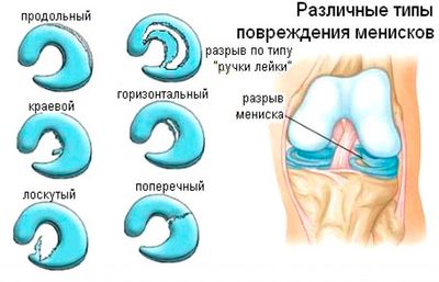 Повреждения мениска