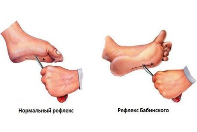 рефлекс Бабинского