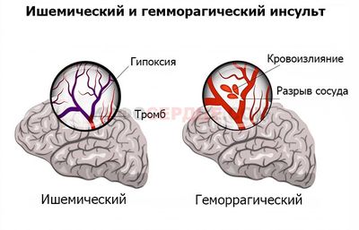 геморрагический и ишемический инсульт