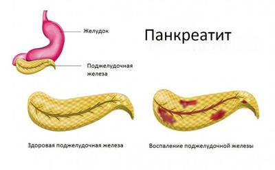 панкреатит