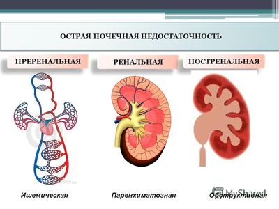 острая почечная недостаточность