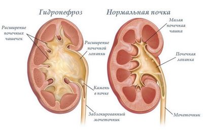 гидронефроз