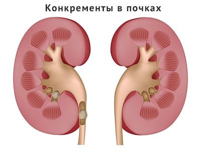 конкременты в почках