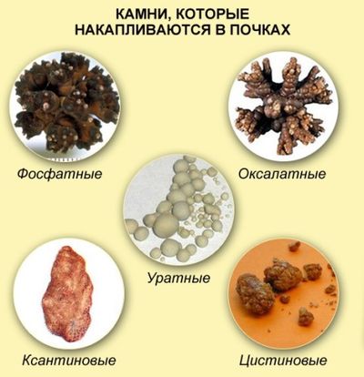 камни которые накапливаются в почках