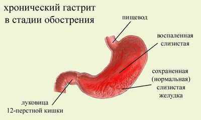 Хронический гастрит