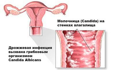 Молочница