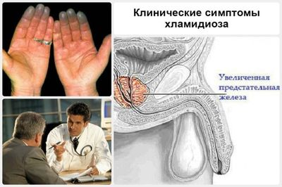 Выделения при хламидиозе
