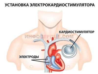 установка электрокардиостимулятора