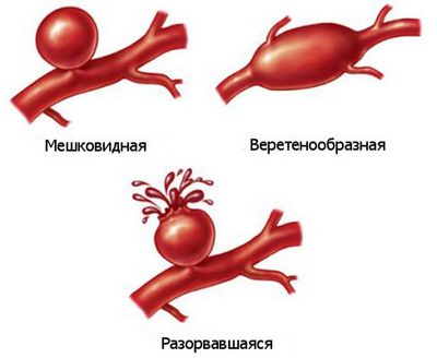 Симптомы и лечение окклюзии артерий ног