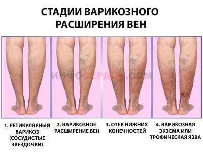 Стадии развития варикоза