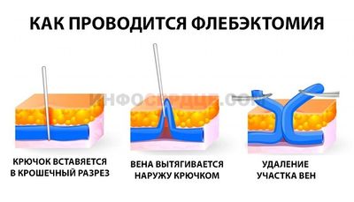 Флебэктомия