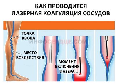 Лазерная коагуляция