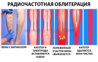 Радиочастотная облитерация