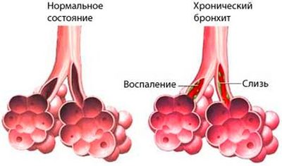 хронический бронхит