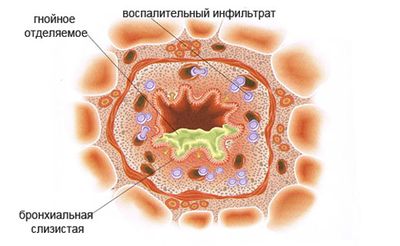 гнойный бронхит