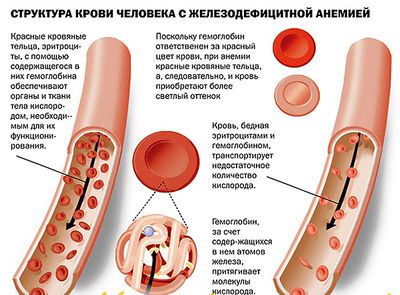 железодефицитная анемия