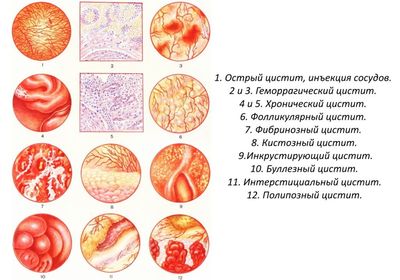 осложнения цистита