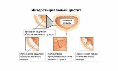 Интерстициальная форма цистита