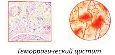 Геморрагическая форма цистита