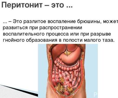 перитонит