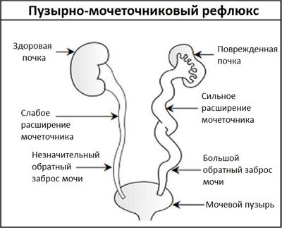 Пузырно-мочеточниковый рефлюкс