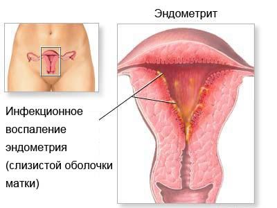 Метроэндометрит