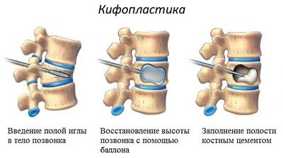 кифопластика