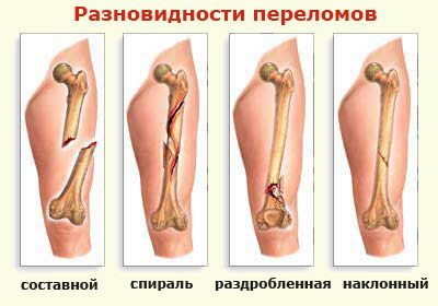 разновидность переломов