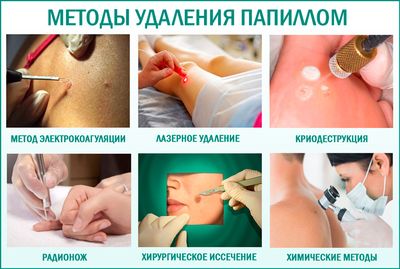 Чем лучше удалять папилломы, каким способом
