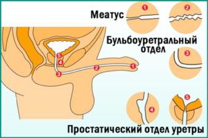 Что такое стриктура уретры у мужчин?