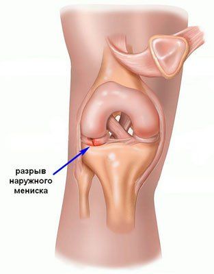 О каких патологиях сигнализирует боль в колене при нагрузке?