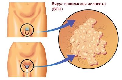 Вирус папилломы человека