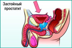 Застойный (конгестивный) простатит