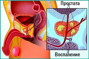 Что такое хронический простатит?