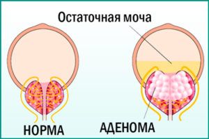 Что такое аденома простаты?