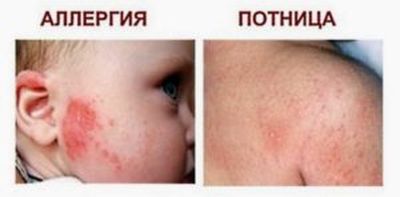 отличить потницу от аллергии