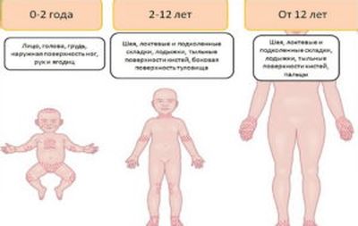 лечение потницы