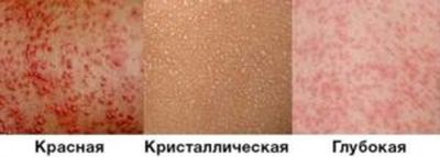 виды потницы