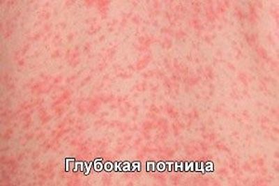 глубокая потница