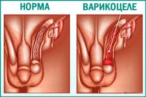 Что такое варикоцеле?