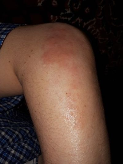 прыщи на коленях