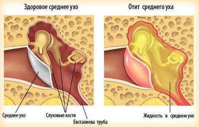 Отит среднего уха