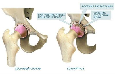 Операция при коксартрозе тазобедренного сустава