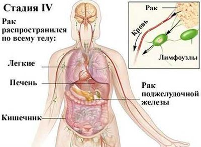 4 стадия рака поджелудочной железы