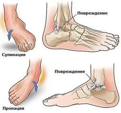 Травма голеностопного сустава стопы