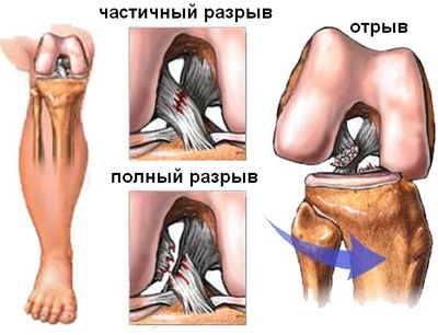 Частичный и полный разрыв