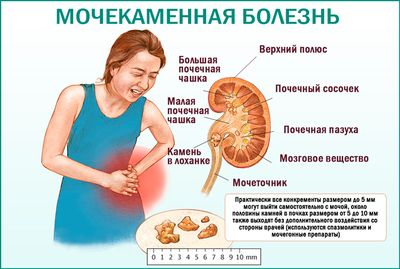 Мочекаменная болезнь (уролитиаз)
