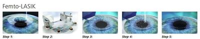 Технология LASIK