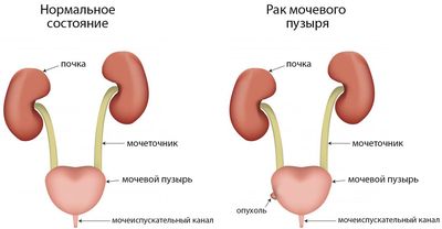 рак мочевого пузыря